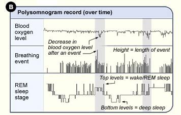 how to read sleep apnea test results.